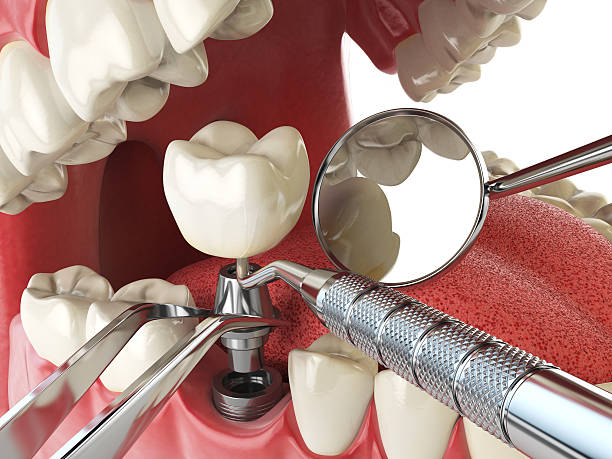 Best Emergency Treatment for Dental Infections or Abscesses in Brush, CO